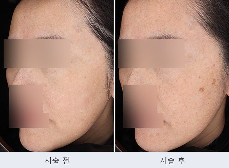 기미 흑자 주근깨